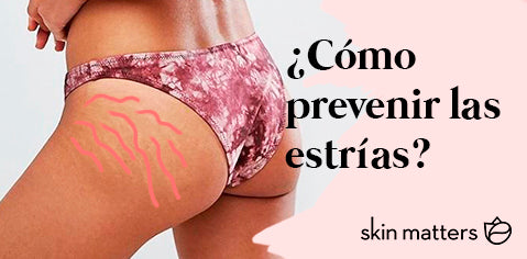 ¿Que son las estrías y como prevenirlas?